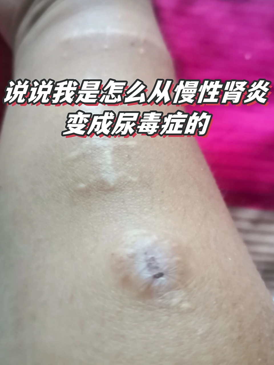 尿毒症的症状有
