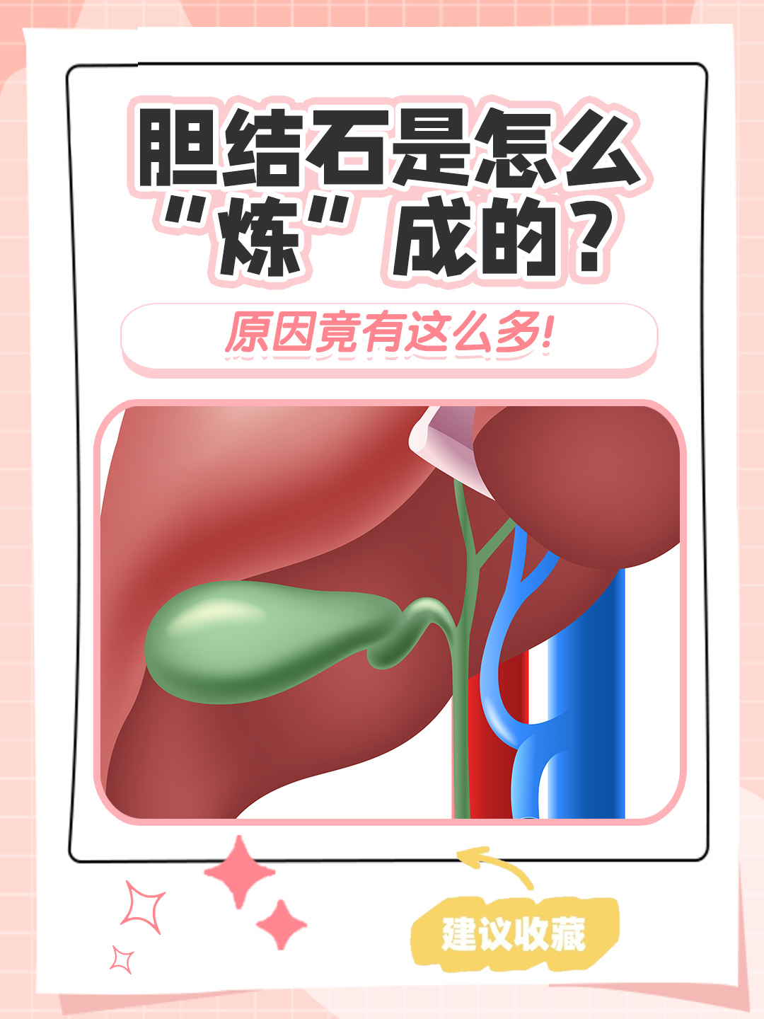 胆结石是哪些原因形成的