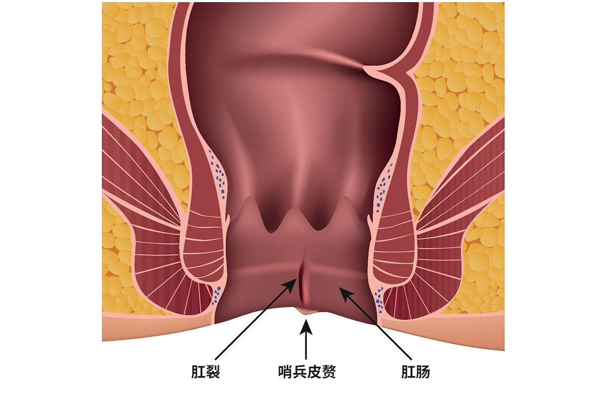 肛裂是什么