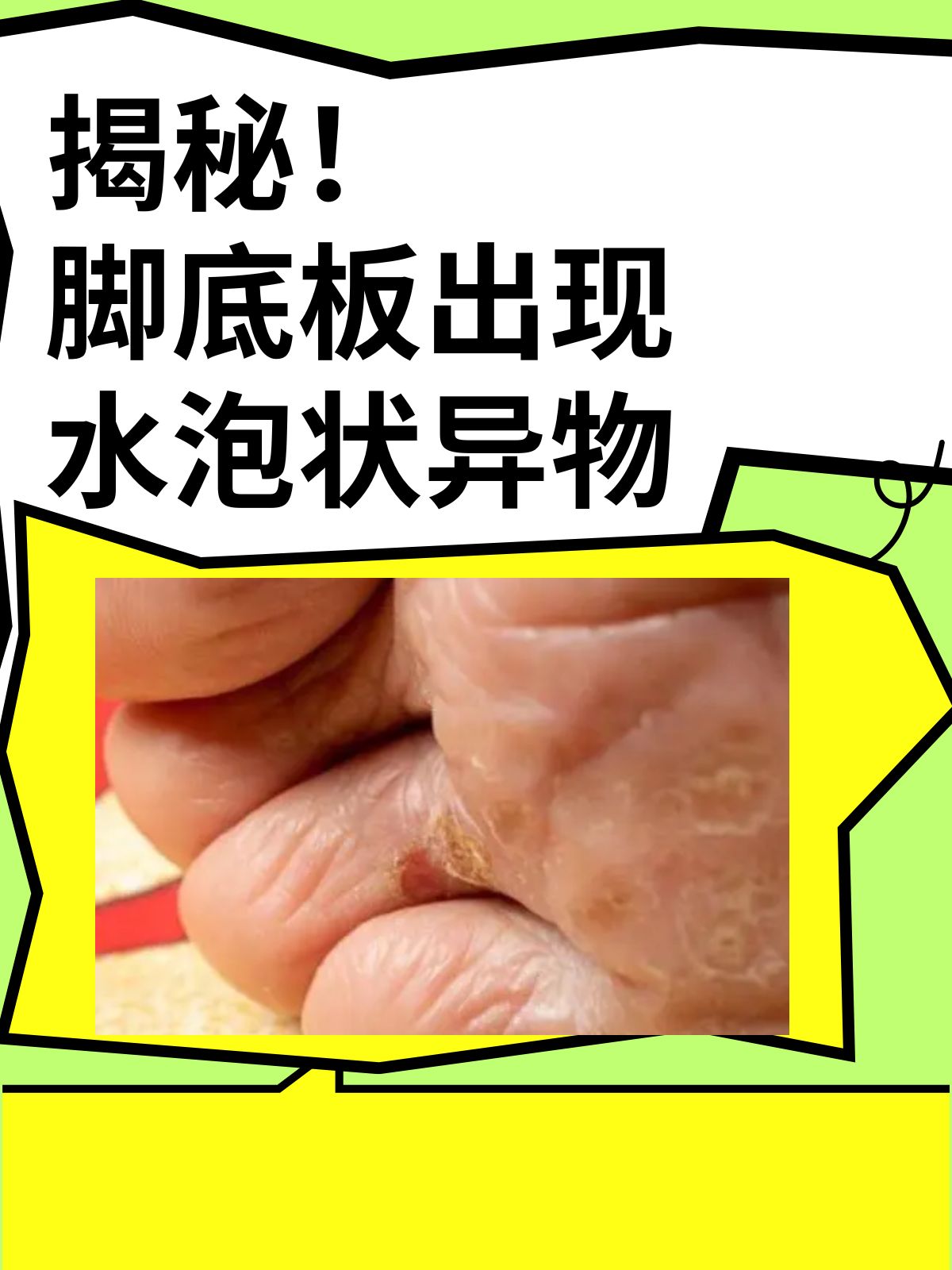 脚上起水泡怎么回事?