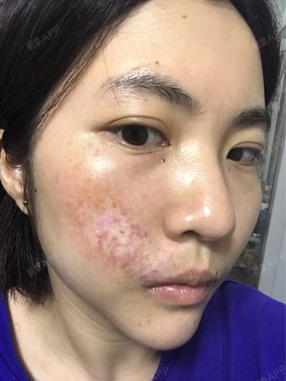 请问激光去红血丝后掉痂后,脸上出现一片片