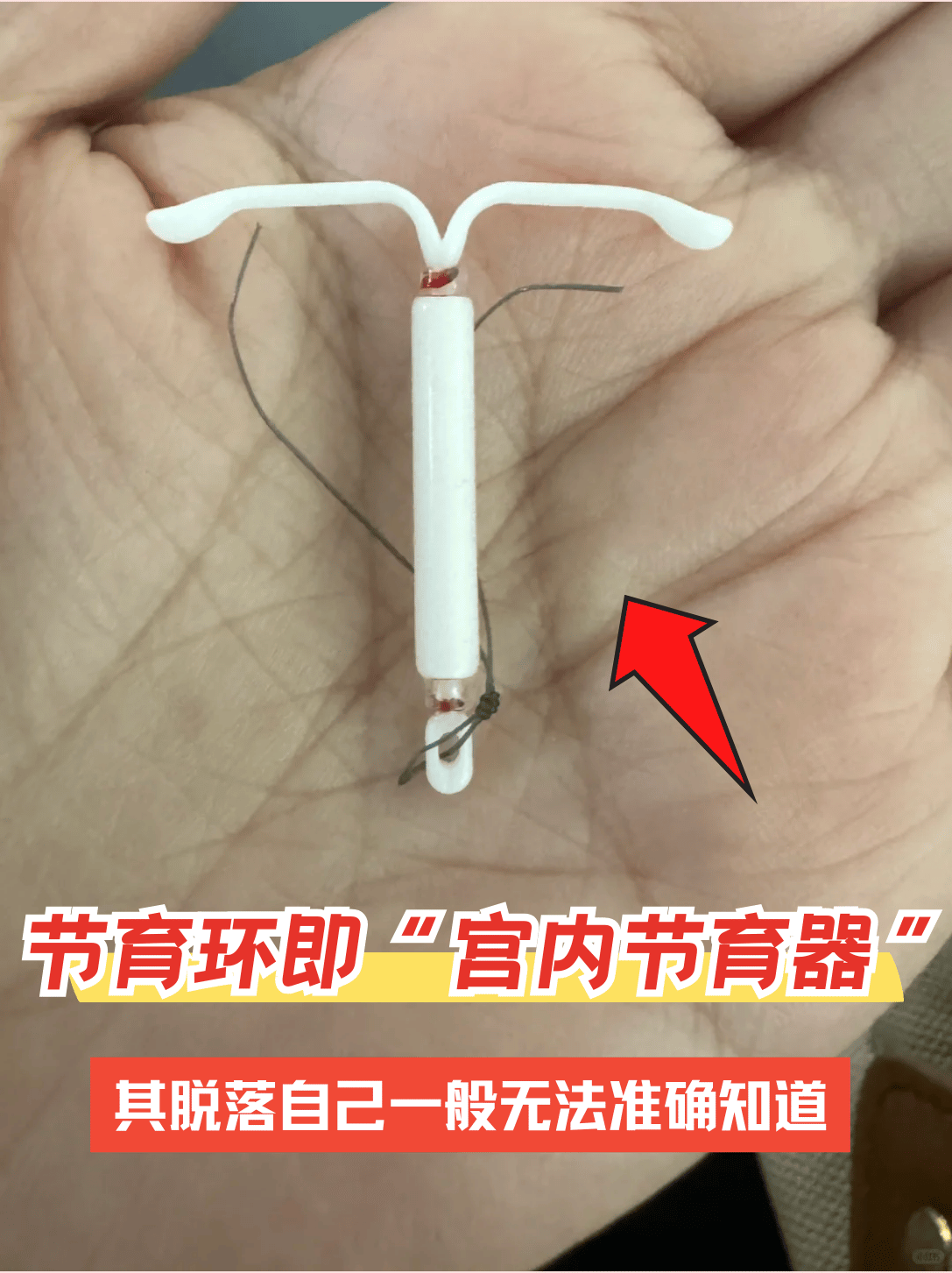 节育环是什么