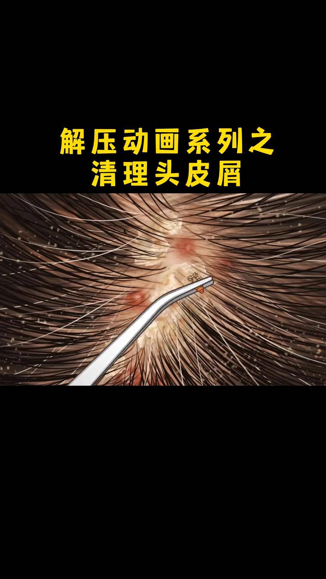 去头皮屑最好的方法有哪些