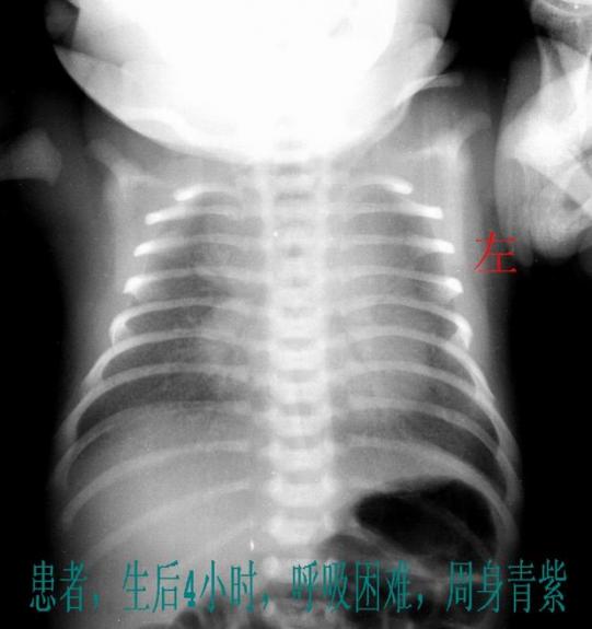 新生儿呼吸窘迫综合征是什么?