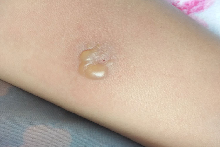 结核PPD实验