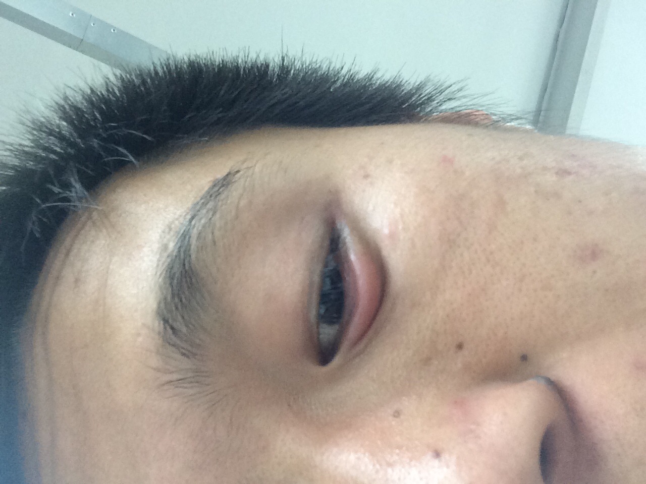 右下眼睑浮肿