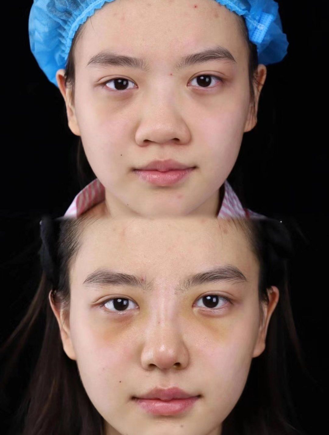 鼻子塌怎么变挺