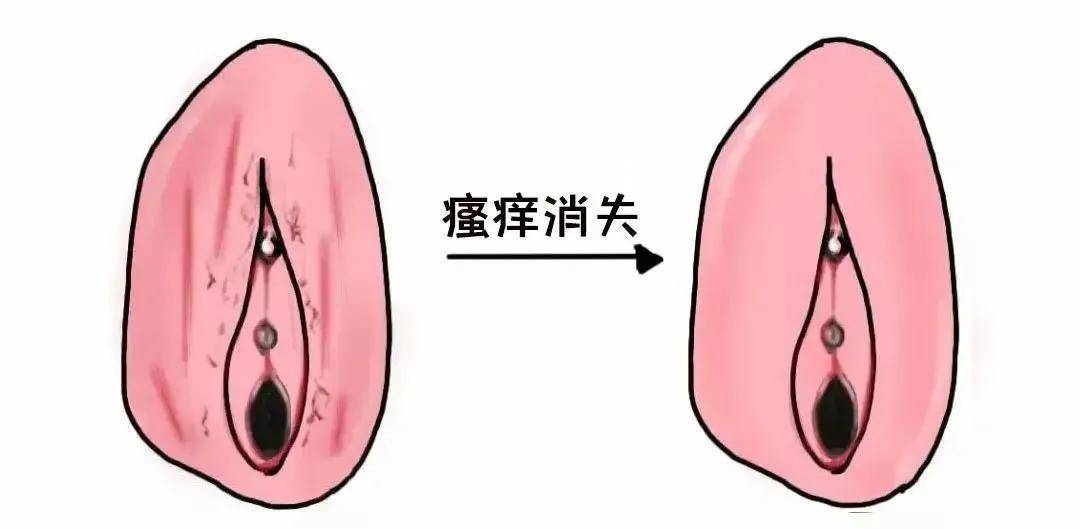 外阴瘙痒红肿怎么回事