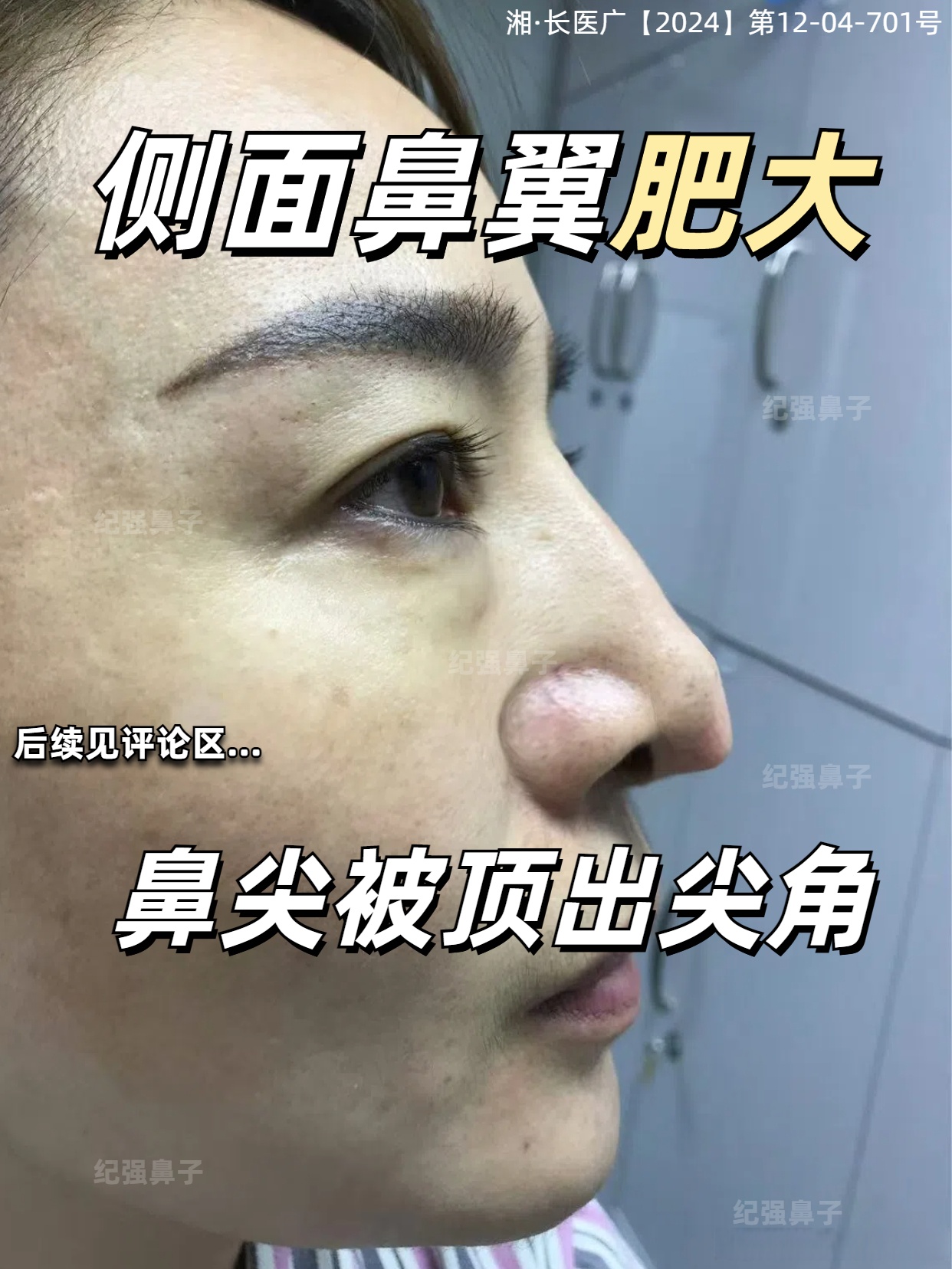 鼻小柱延长是怎么回事?
