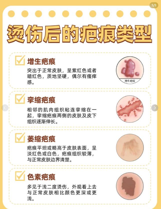 浅二度烫伤多久可以好