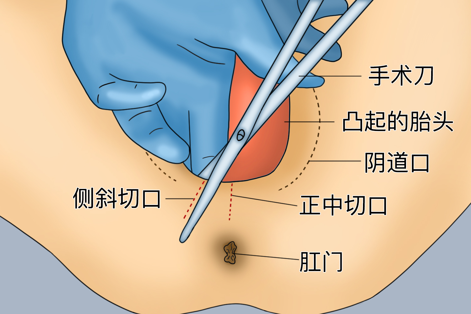 我的侧切伤口这是发炎化脓了吗