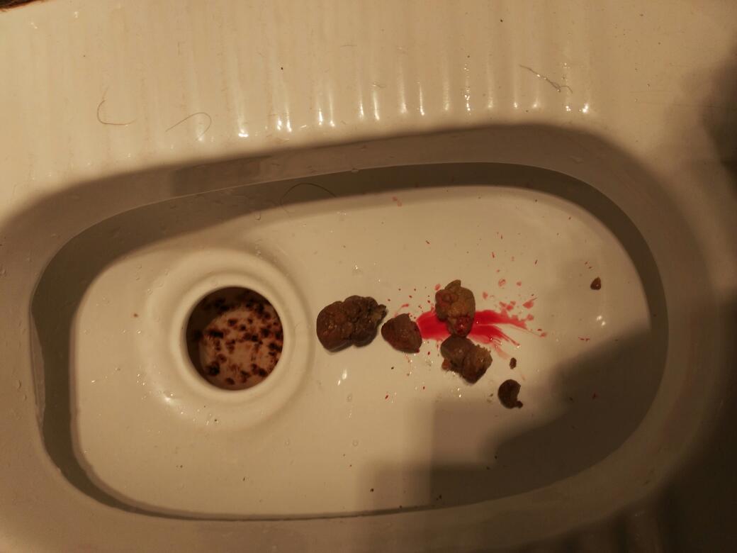 大便时有血