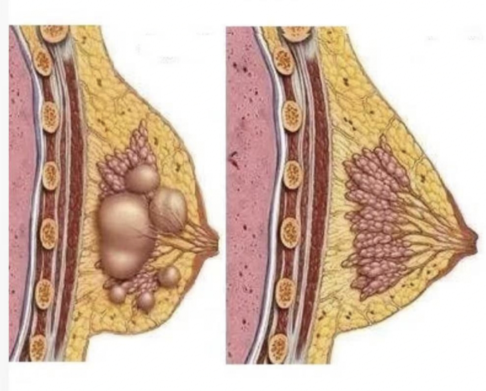 乳房里有硬块
