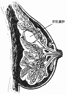 乳房里有硬块