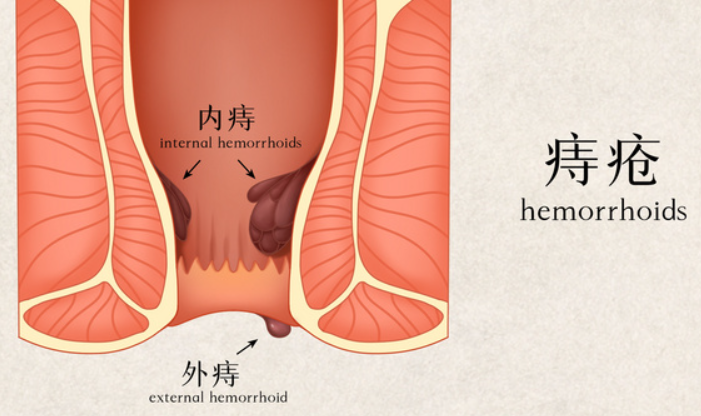 痔疮长在什么部位