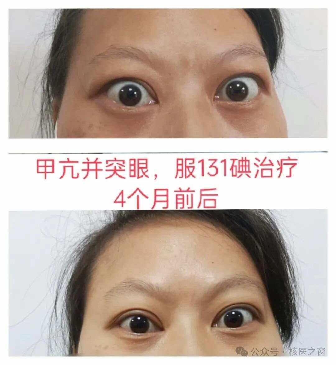 甲亢眼睛突出怎么消