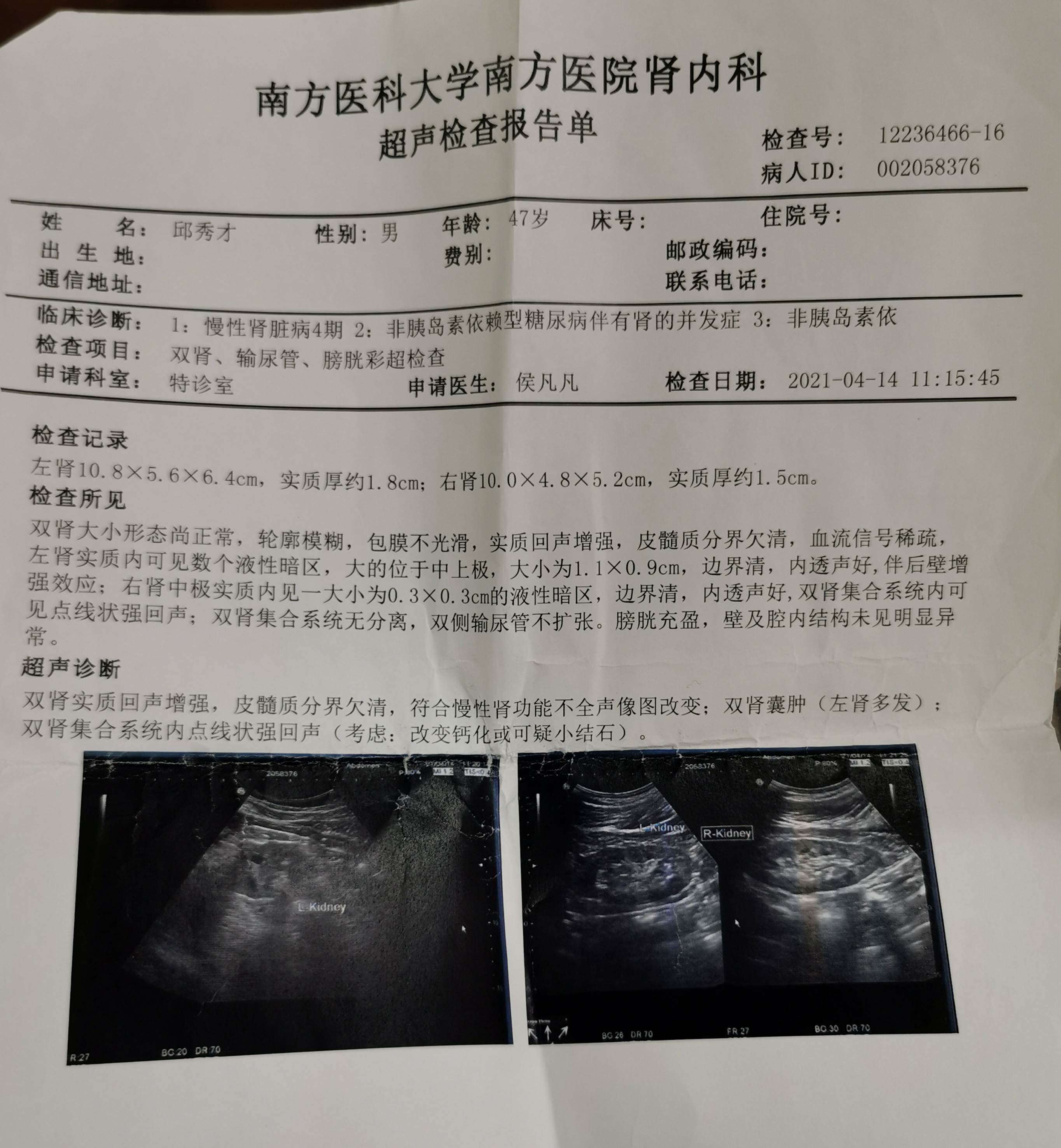 肾移植需要多少钱?