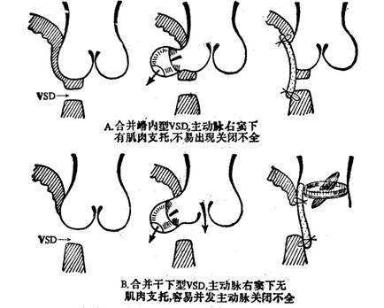 室间隔缺损3mm严重吗