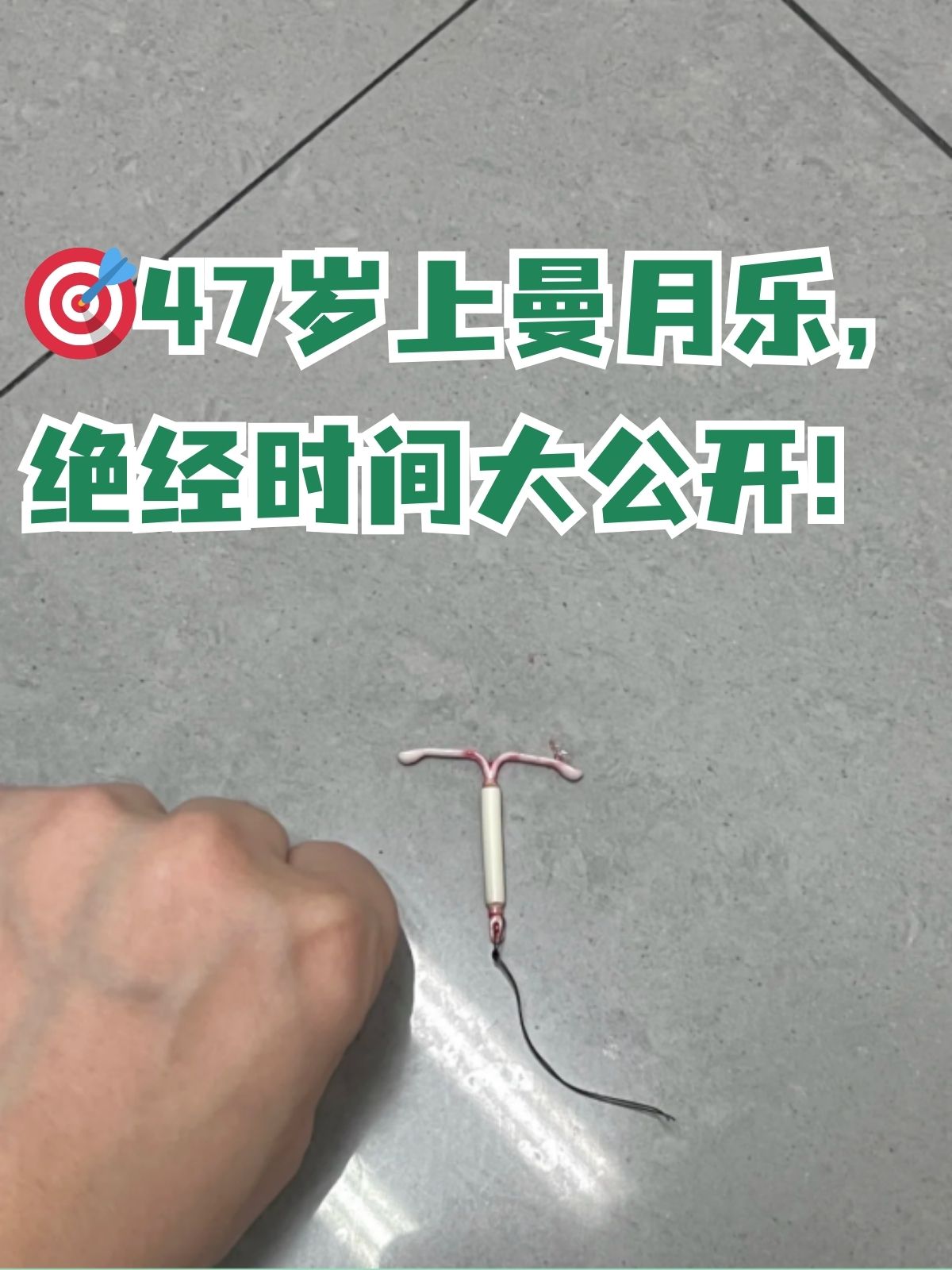 曼月乐避孕环