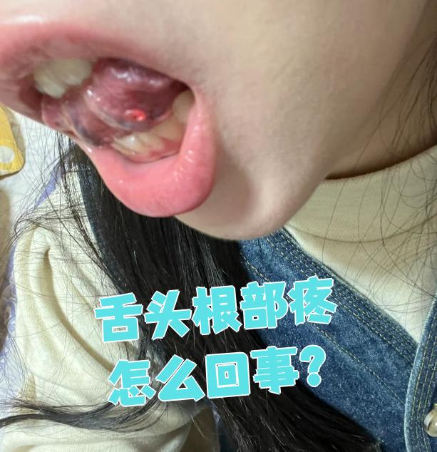 舌头根部疼是怎么回事