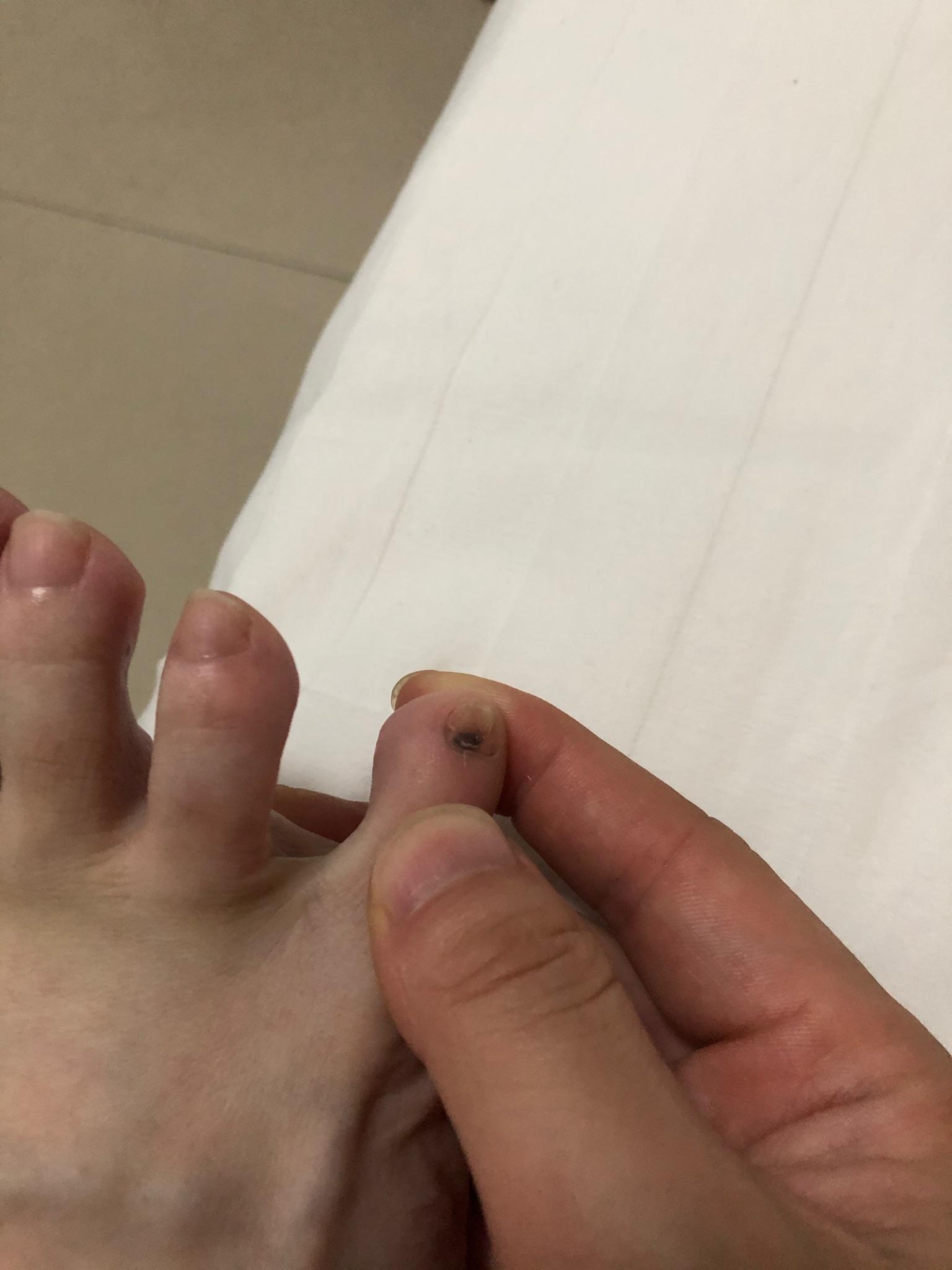 脚趾甲有一小块变黑了