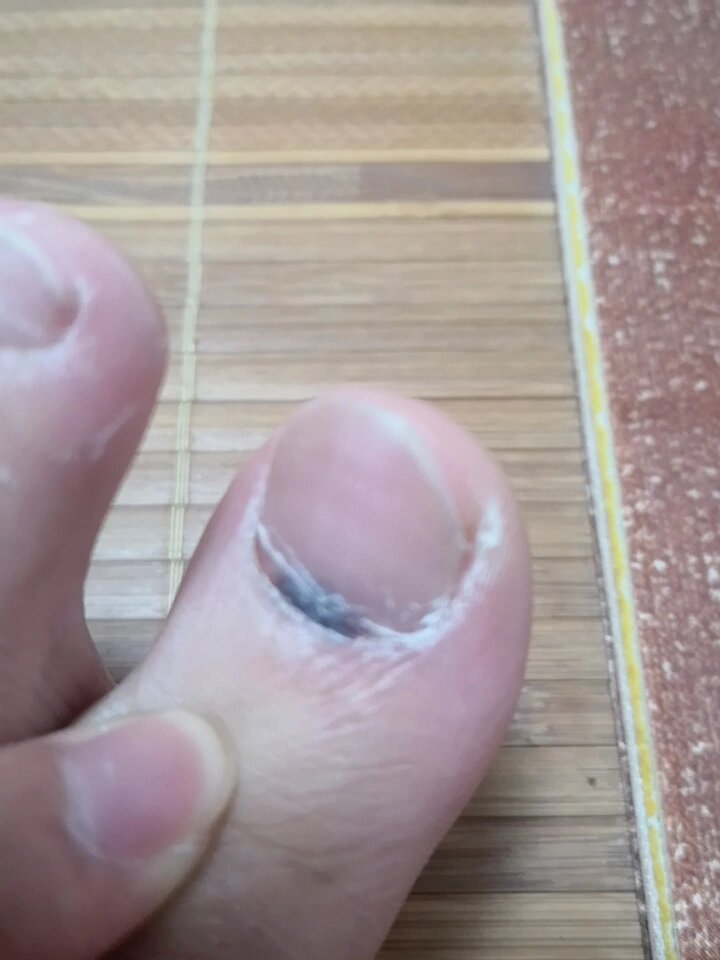 脚趾甲有一小块变黑了