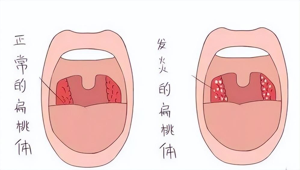 扁桃体在哪个部位