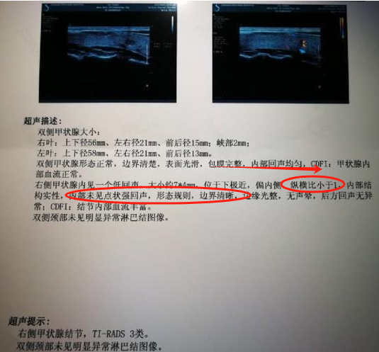 低回声结节是什么