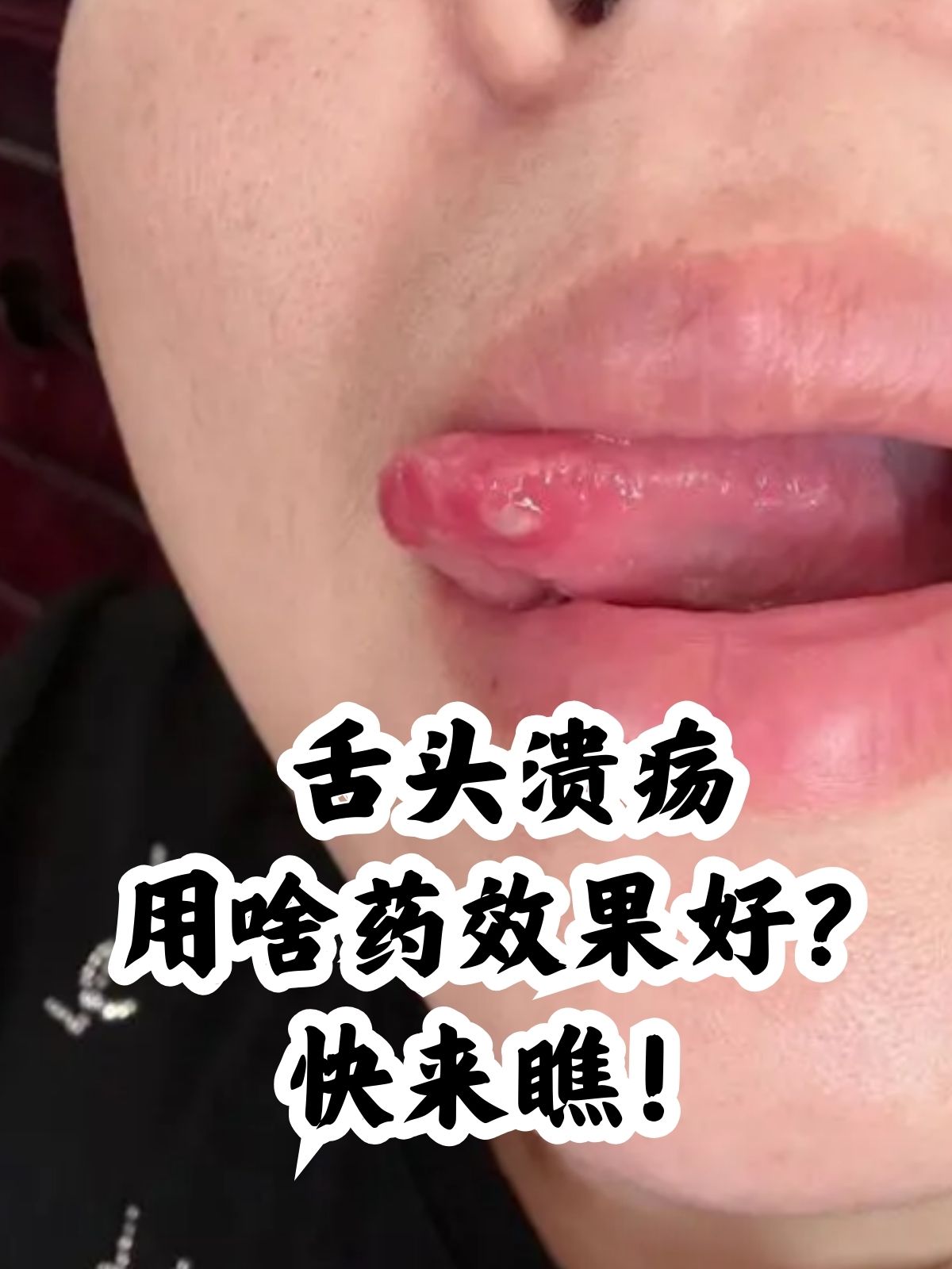 口腔溃疡吃什么好的快