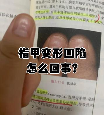 手指甲有凹陷是怎么回事