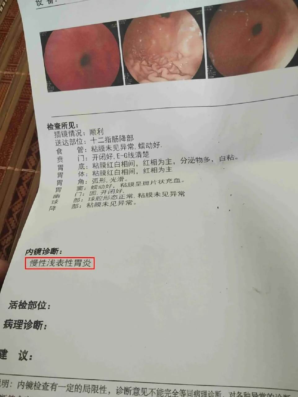浅表性胃炎的症状是什么