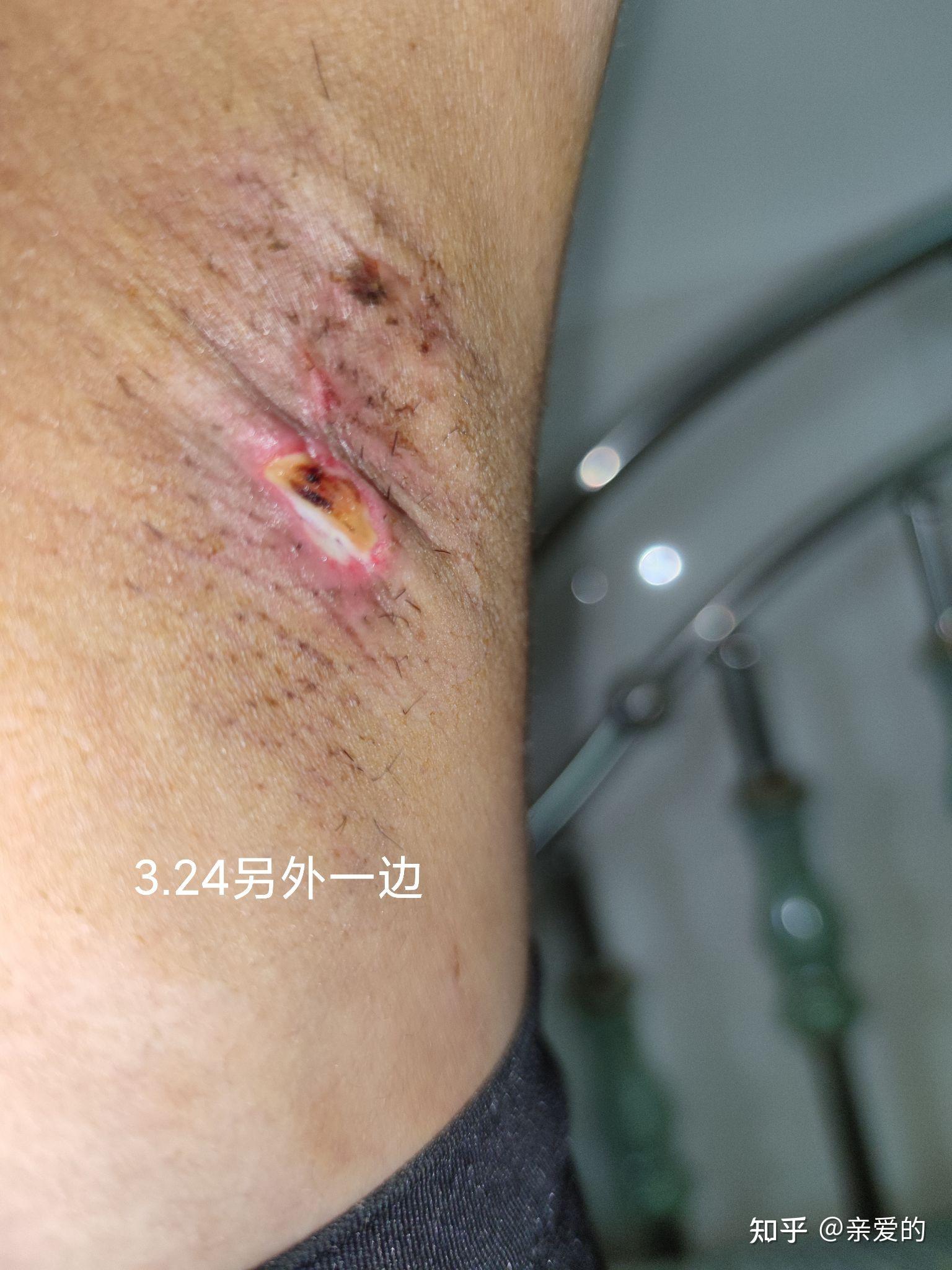 手术治疗狐臭