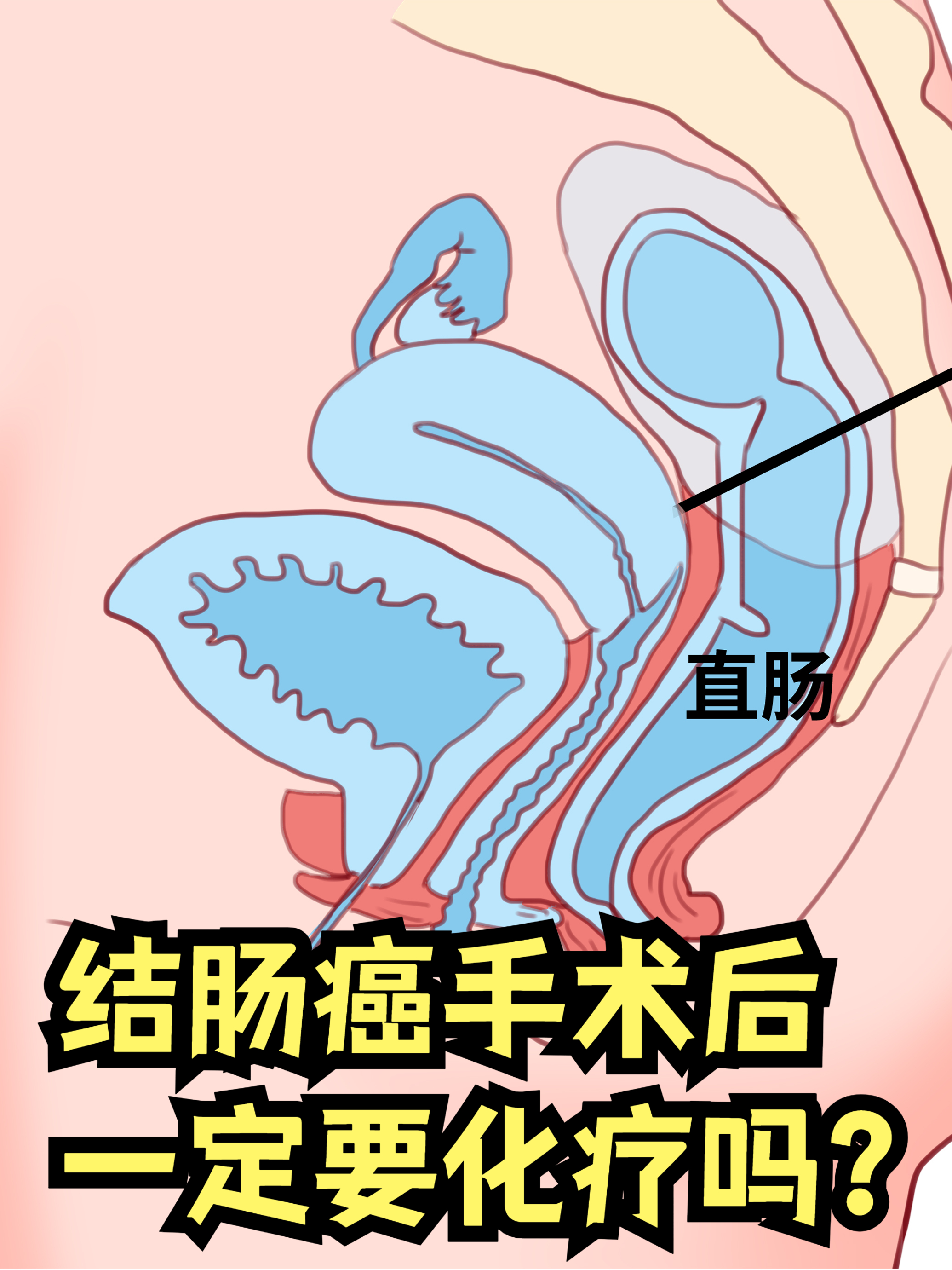 结肠癌术后需要化疗吗?