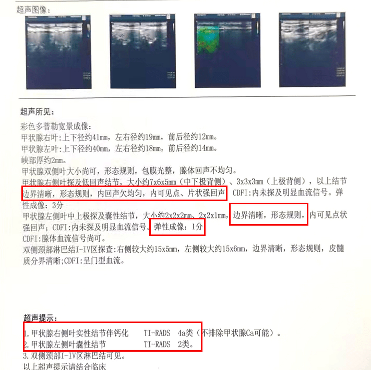 甲状腺结节钙化是啥意思