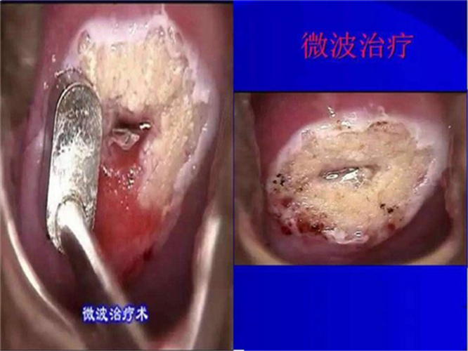 中度宫颈糜烂严重吗