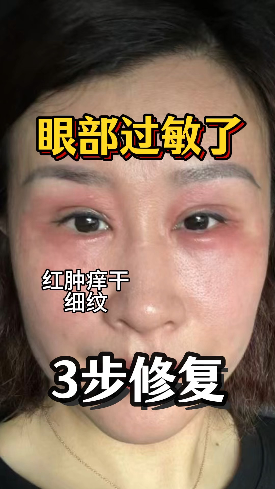 上眼皮痒是怎么回事?
