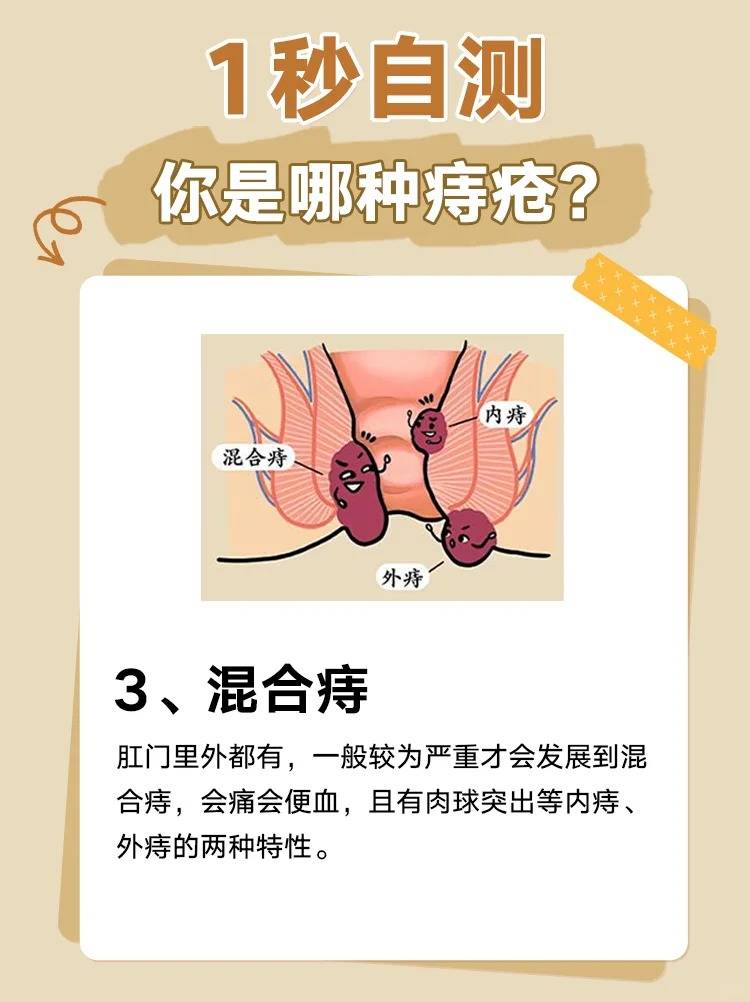 肛门外痔疮