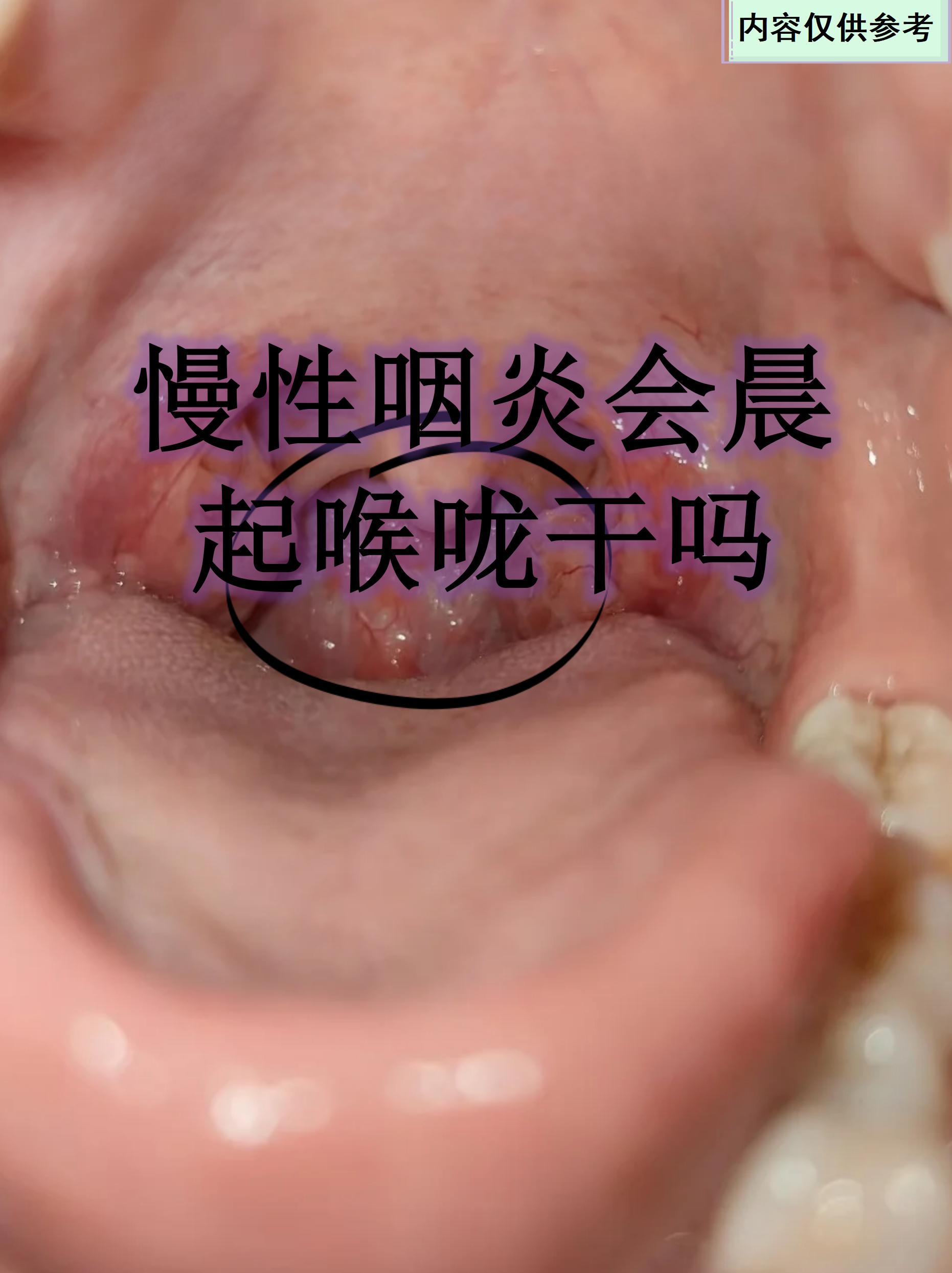 慢性咽炎会癌变吗?