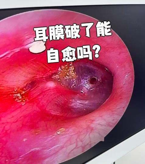 什么是中耳炎