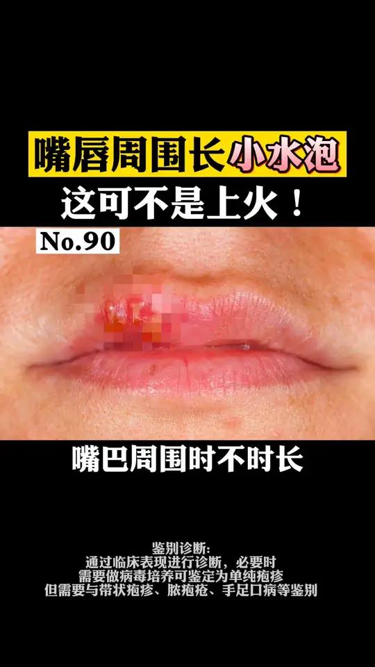 嘴角起泡有点痒怎么办