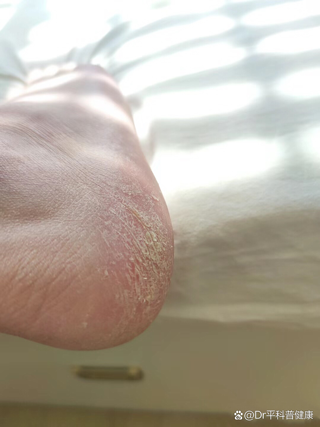 冬天脚后跟干裂的原因