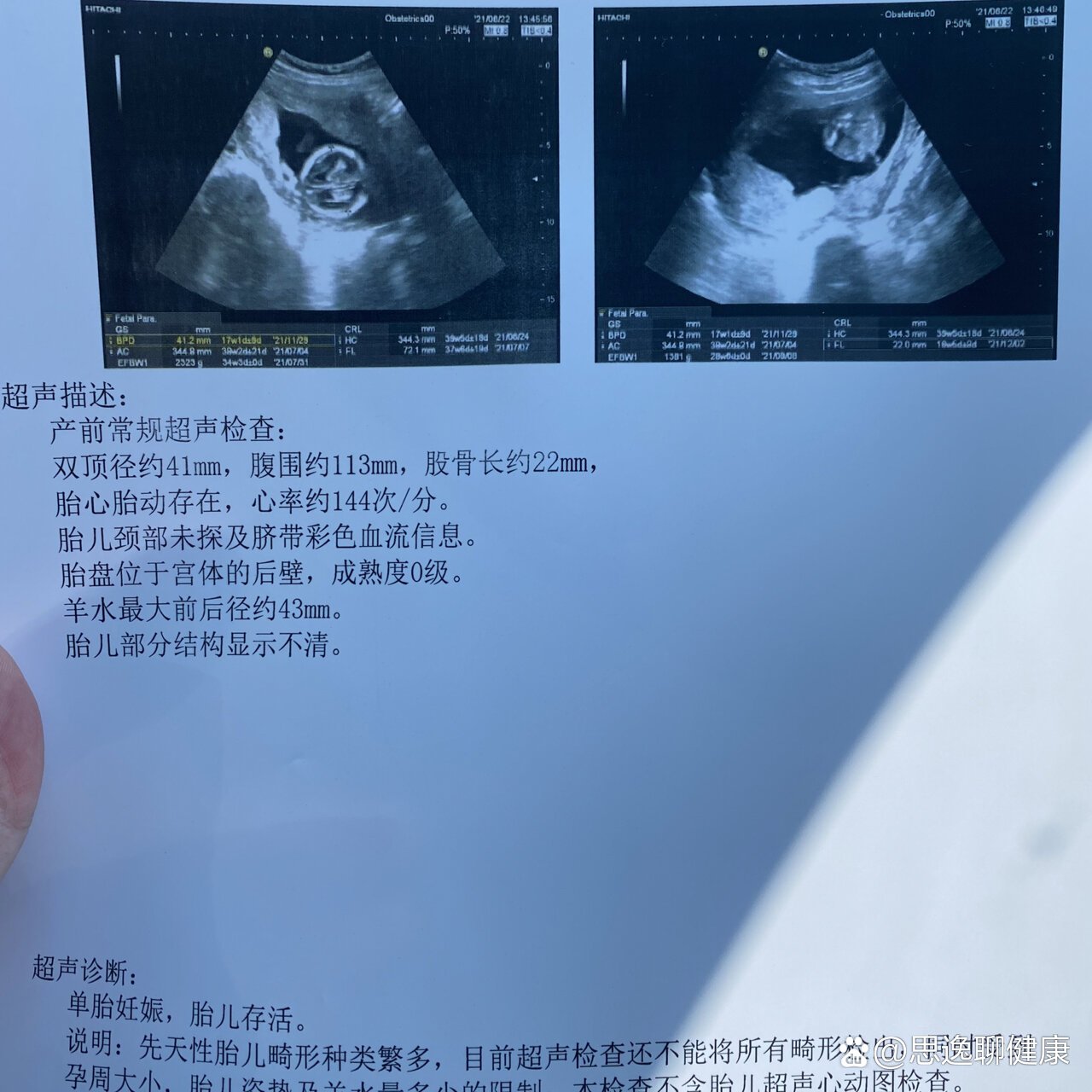 胎儿腿短是什么原因引起