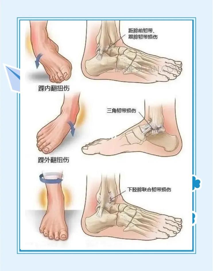 崴脚了咋办