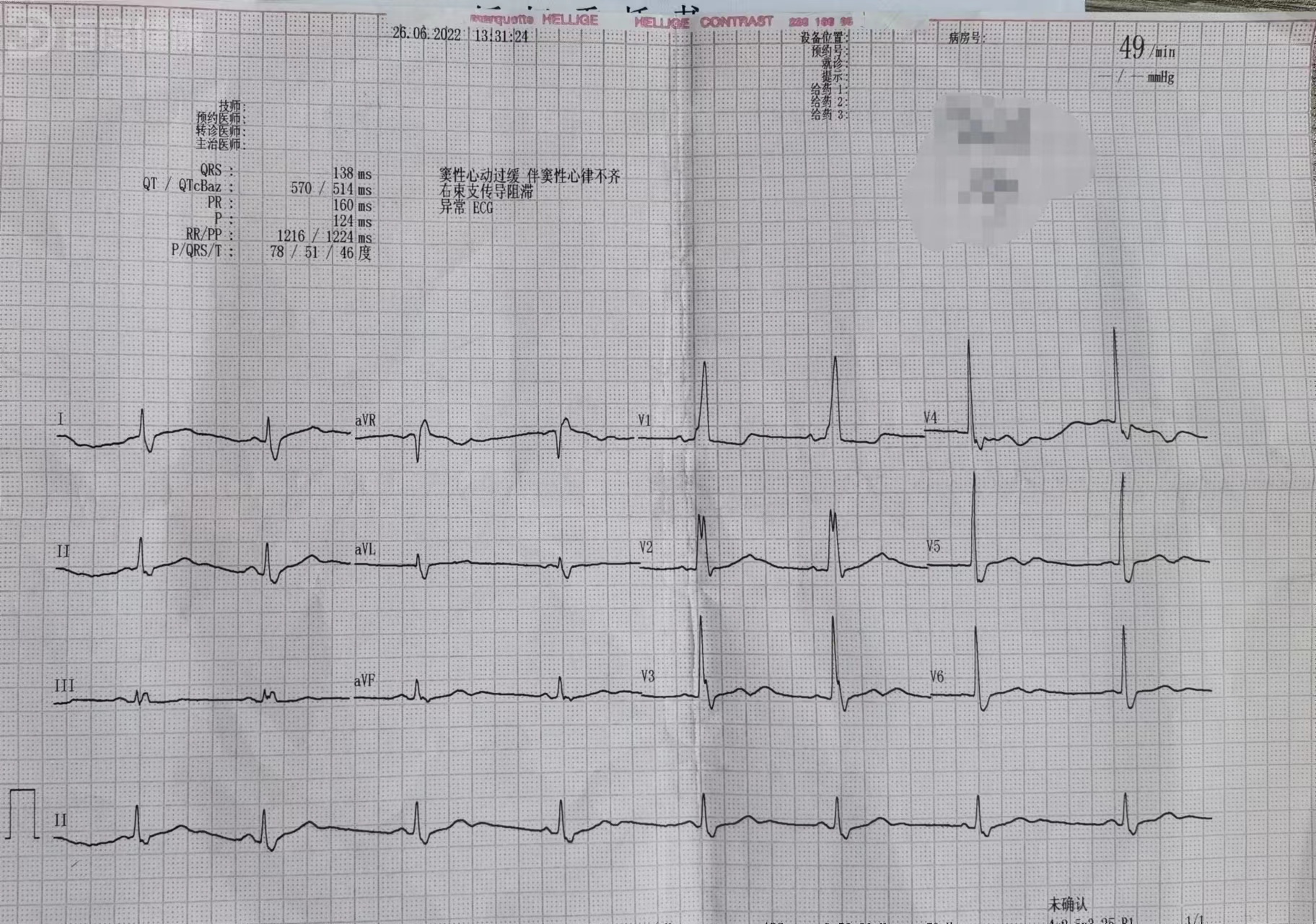右束支传导阻滞严重吗
