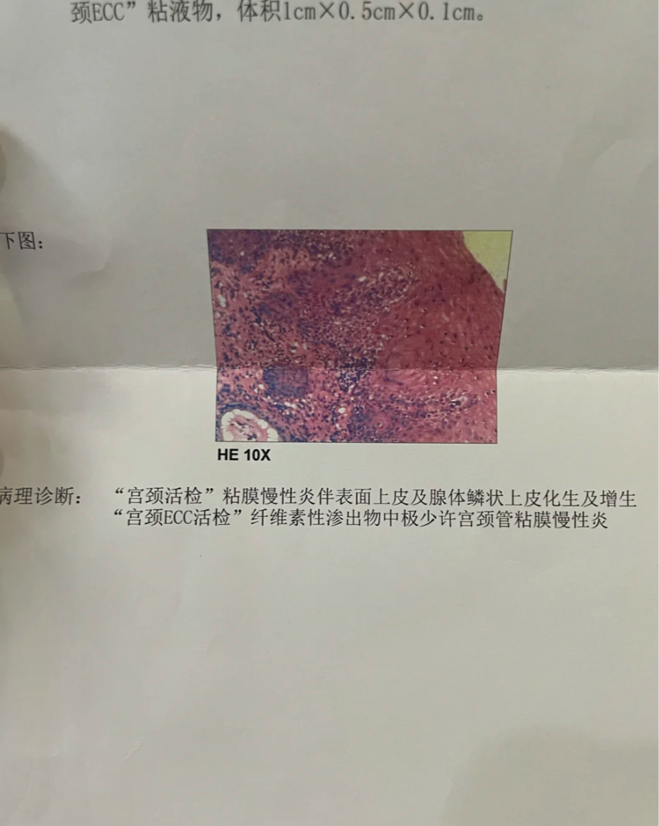 白带里有血丝是怎么回事