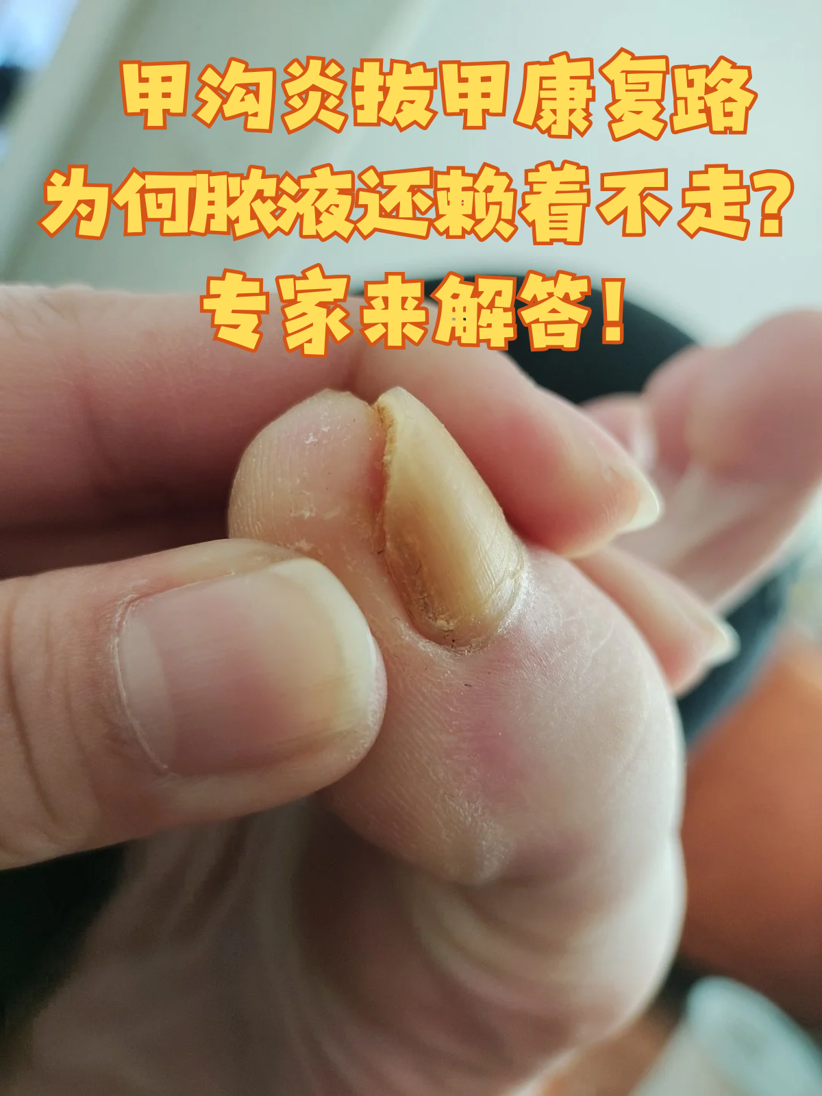 甲沟炎长肉芽了怎么办