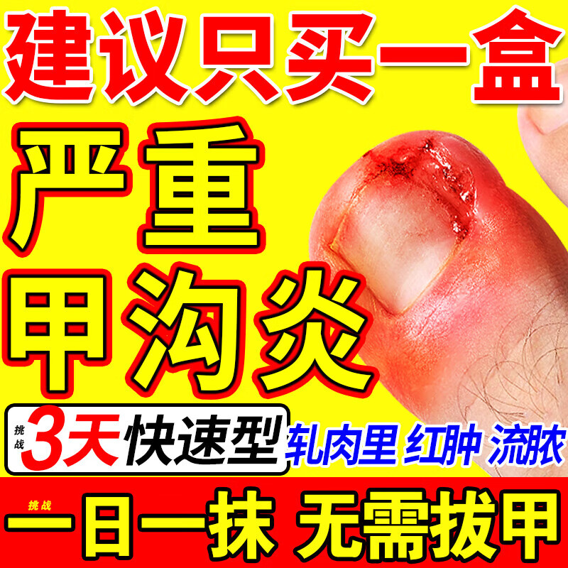 甲沟炎长肉芽了怎么办