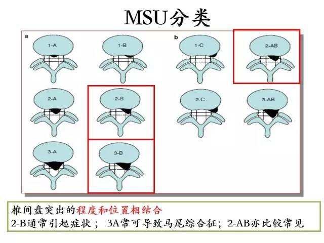 腰椎间盘突出的分型
