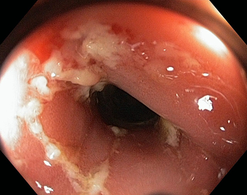 肛门癌的症状表现有哪些