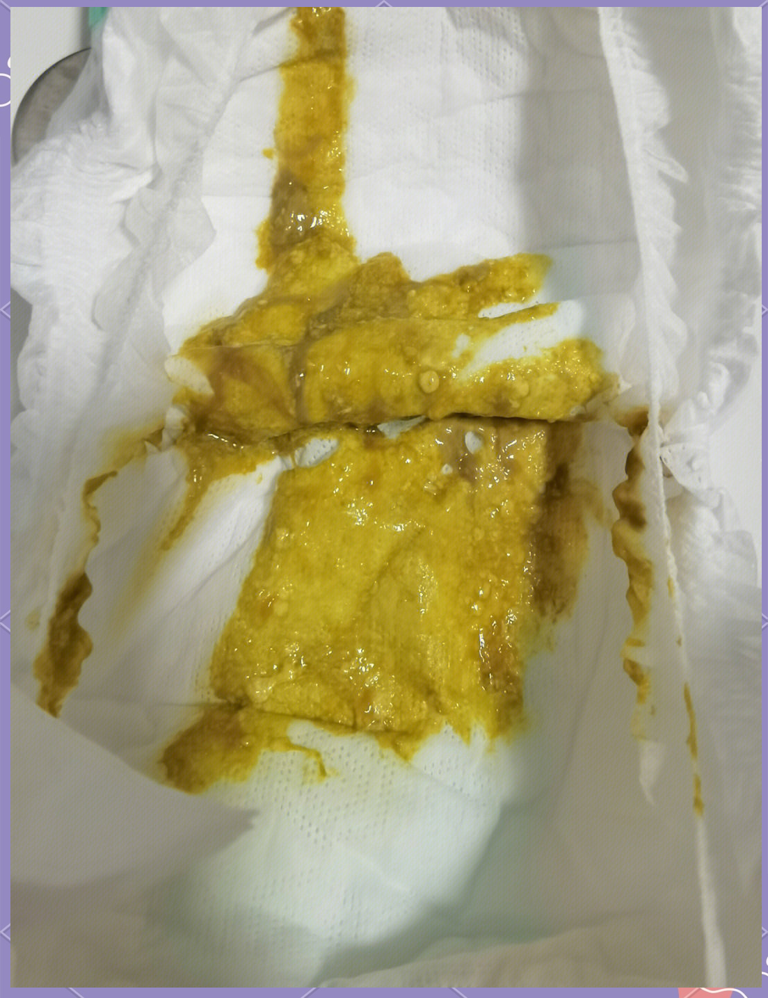 宝宝大便为什么有粘液